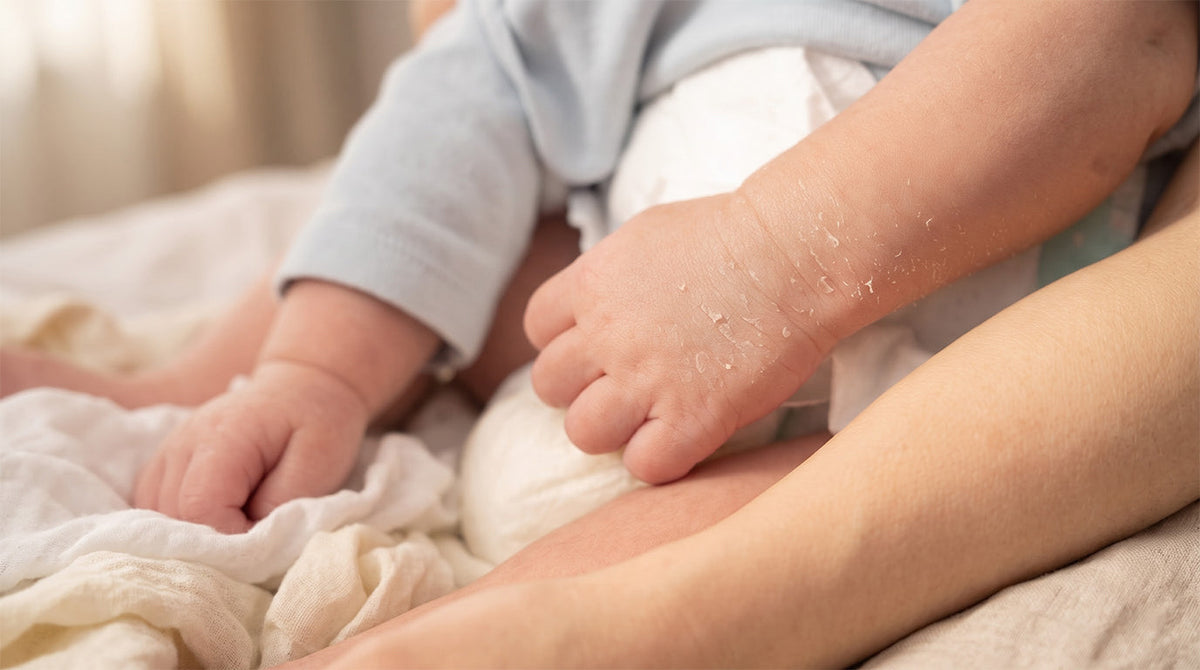 Newborn Rashes &amp; Sensitive Skin — What’s Normal and What’s Not