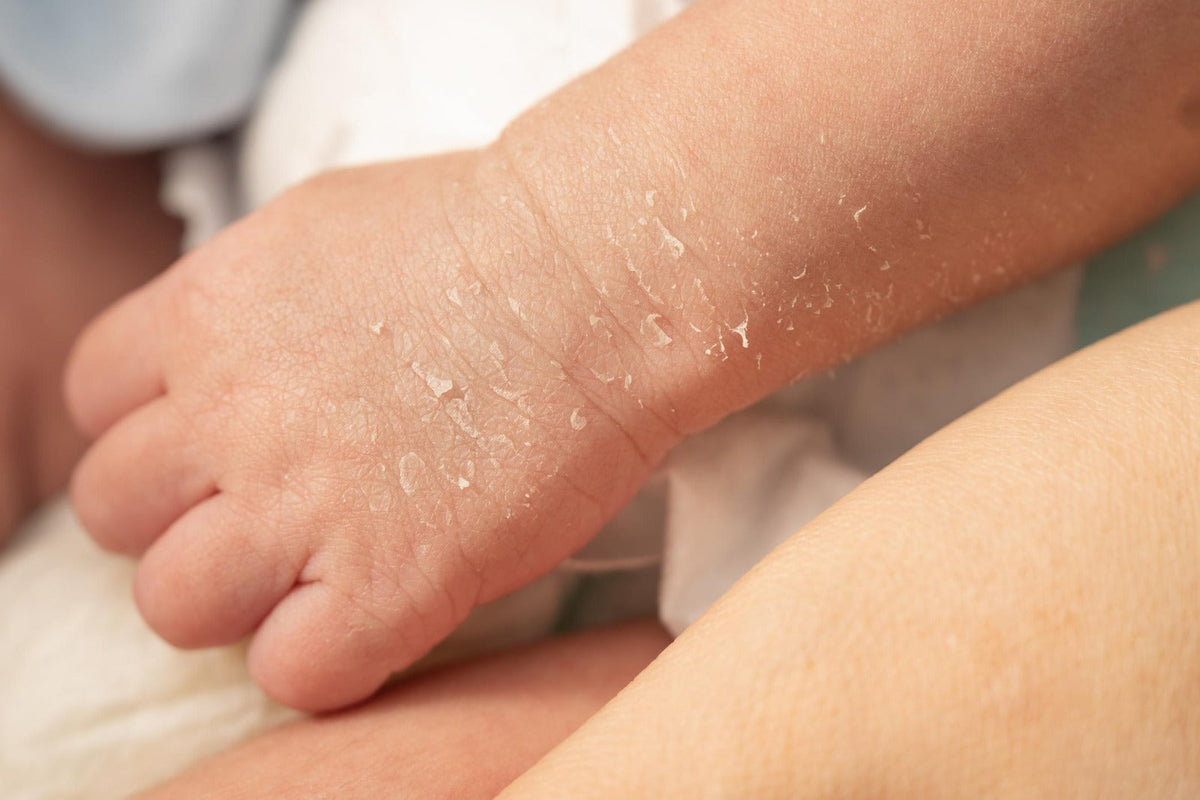 Newborn Rashes &amp; Sensitive Skin — What’s Normal and What’s Not